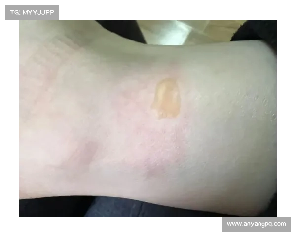福建女子睡醒全身红疹,越挠越痒!原来背后竟是这种原因(睡醒身上起红疙瘩) 福建女子睡醒全身红疹,越挠越痒!原来背后竟是这种原因(睡醒身上起红疙瘩)